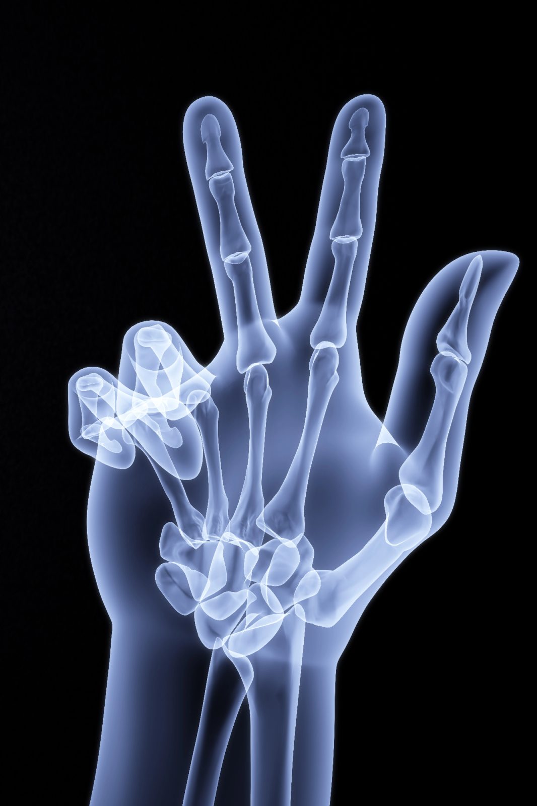 Kaj je dupuytrenova kontraktura in kdaj zdraviti